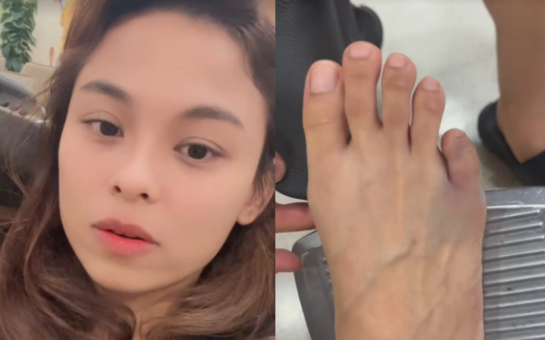 Lantai rumah basah, jari kelingking kaki Myra Natasha patah akibat tergelincir