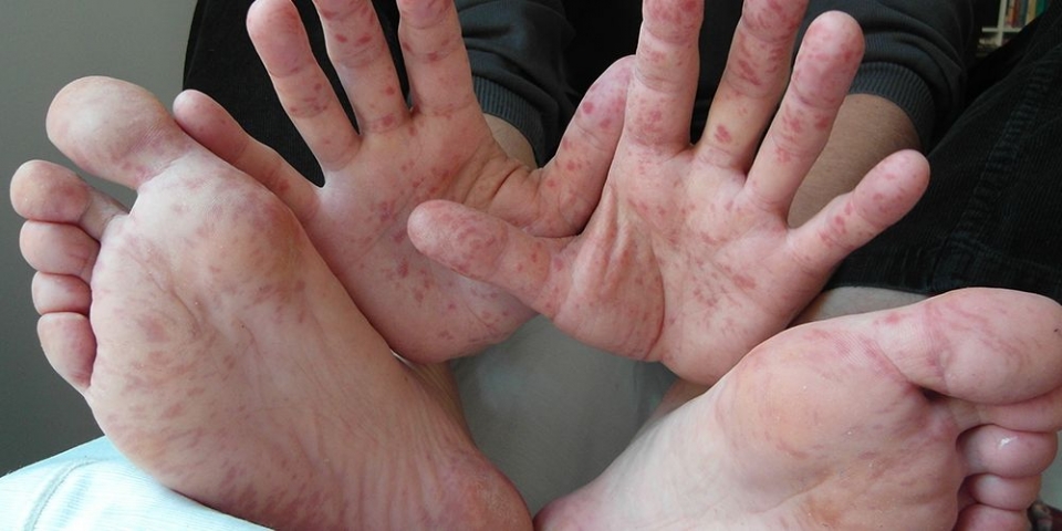 HFMD rekod 99,601 kes, Selangor catat jumlah tertinggi