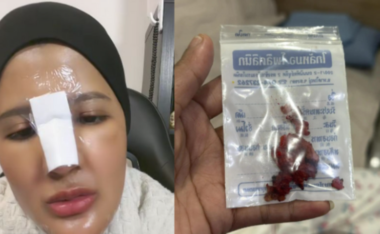 Nilam Ortiz keluarkan silikon hidung, plan nak buang tatu