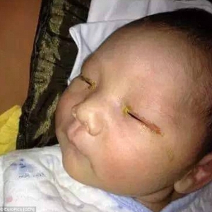 Bayi Buta Sebelah Mata Akibat 'Flash' Kamera