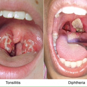 Diptheria, Sesalan Si Anti Vaksin!