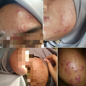 Lagi Kes Produk Kosmetik Tempatan Rosakkan Kulit Pengguna