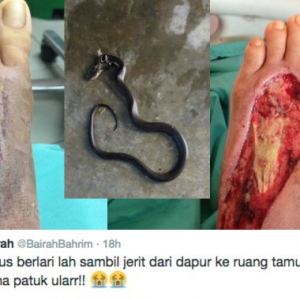 "Tolong, Aku Kena Patuk Cobra" Wanita Ini Kongsi Detik Cemas Dipatuk Ular