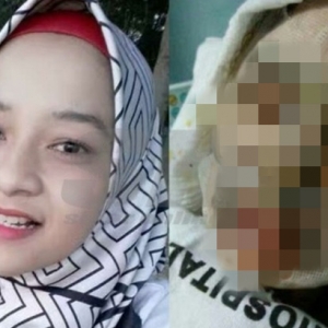 Muka Teruk Melecur & Nyaris Buta, Gadis Pitam Ketika Menggoreng Kuih