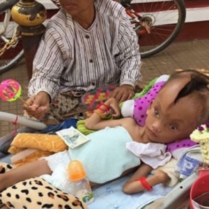 Rekahan 10cm Di Atas Tengkorak, Kanak-kanak 6 Tahun Menderita Sejak Lahir