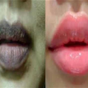 Akak, Jom Merahkan Bibir Secara Alami. Selamat Tinggal Bibir Hitam