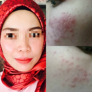 Lagi Netizen Mengadu, Produk Kosmetik Tempatan Merosakkan Wajahnya!