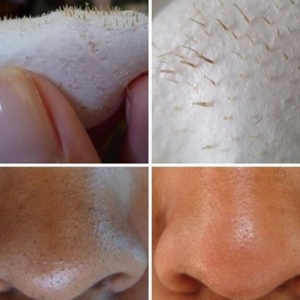 Paling Senang, DIY Masker Singkirkan Blackhead Pada Hidung