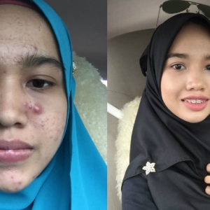 Hanya 4 Bulan Hilangkan Jerawat Batu, Amalan Gadis Ini Bukan Lagi Rahsia