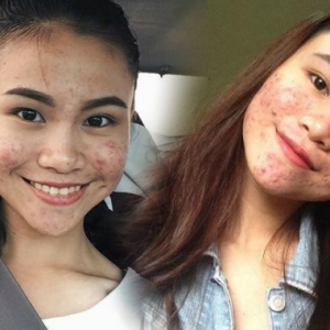 Ubah Kekurangan Jadi Kelebihan, Gadis Ini Popular Sebab Muka Penuh Jerawat