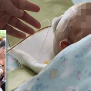 Tempurung Kepala Pecah, Bayi Dihempap Epal Kini Kritikal