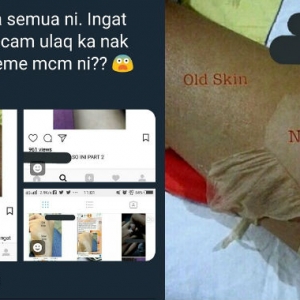 "Ingat Ular Ke Boleh Salin Kulit? Nak Putih Sangat Pun Jangan Jadi Bodoh"