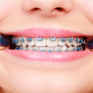 Braces, Trend Atau Keperluan ? 5 Perkara Ini Anda Perlu Tahu Sebelum Pakai Braces