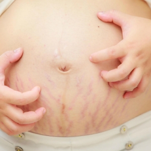 Rahsia Hilangkan Stretch Marks, Guna Susu Badan Sendiri