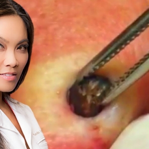 Kenali Dr. Pimple Popper, Pencetus Video Menjijikkan Tapi Bikin Ketagih Di Youtube