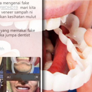 Punya Nak Cantik, Tapi Pakai Fake Veneer. Itu Semua Produk Sampah!