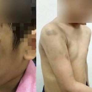 "Kena Pukul Daddy" - Kasihan, Budak 5 Tahun Didera Teman Lelaki Ibu..