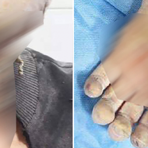 Cegah Covid-19, Lelaki Terbakar Lepas Sapu Disinfektan Satu Badan