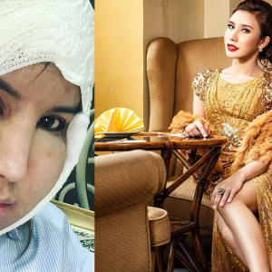 Safiey Illias Bakal Buat Pembedahan Kecilkan Pipi Di Klinik Rawatan Rambut?