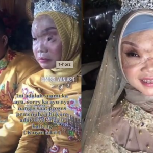 Wajah Cacat Terkena Enjin Bot, Pengantin Lelaki Dipuji Terima Pasangan Seadanya