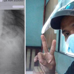 Lelaki Terkejut X-Ray Tunjuk Mata Pisau Tertanam Di Dada