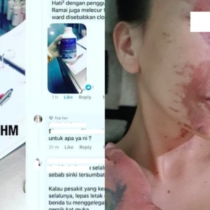 Muka Melecur Teruk Gara-Gara Cuci Singki Tersumbat