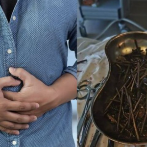 Telan 1kg Paku, Skru Dan Logam Sejak Berhenti Minum Alkohol