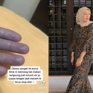 Gadis Ketakutan Tangan Jadi Biru- Obses Diet Sampai Tak Makan, Hanya Minum Air Mineral