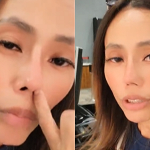 "Suka Mengata, Hati Orang Melayu Hitam,"-Lana Nodin Buat Hidung Sebab Kemalangan, Baru Ganti Dengan Tulang Telinga