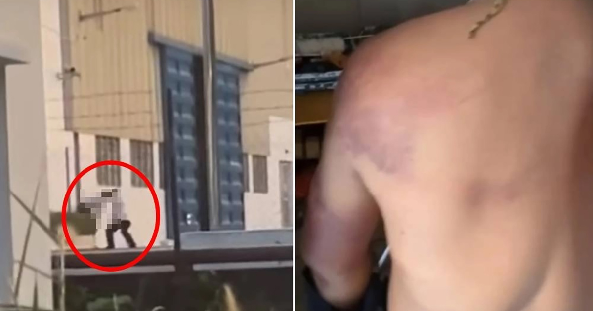Belakang Badan Merah Pekerja Kilang Dipukul Majikan
