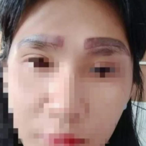 Wanita Malu Besar- Orang Klinik Salah Cacah Tatu, Terpaksa Hidup Dengan Empat Kening