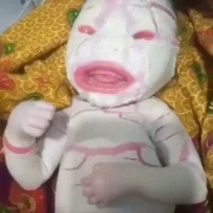 Bayi Lahir Dengan Penyakit Harlequin Ichthyosis Berwajah ‘Ultraman’