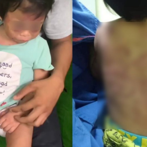 Budak 2 Tahun Lunyai Didera Boyfriend Ibu Sebab Buat Bising- Dipukul Guna Hanger, Ditampar Sampai Lebam Berbirat