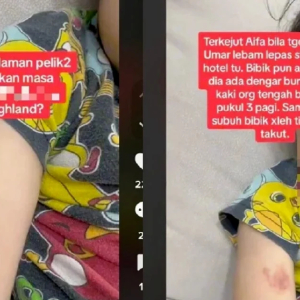 Dengar Bunyi Tapak Kaki Berjalan 3 Pagi, Terkejut Tengok Lengan Anak Lebam