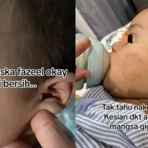 Kesan Bulatan Merah Di Pipi, Ibu Berang Cikgu Taska Tak Bagitahu Anak Digigit! Beri Alasan Gigitan Tak Kuat, Budak Pun Tak Nangis