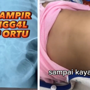 Nyaris Maut, Perut Bayi 4 Bulan Kembung Teruk Tak Boleh Berak Dek Kejahilan Ibu Bapa Suap Pisang Dan Nasi