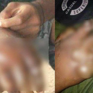 Meraung Tangan Bengkak Dan Melepuh, Pelajar Dakwa Guru Celup Dalam Air Mendidih Di Asrama