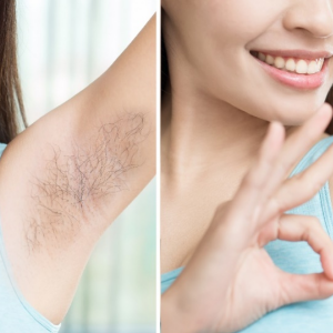 Kulit Halus Tanpa Bulu Sepanjang Masa? Laser Hair Removal Jawapannya!